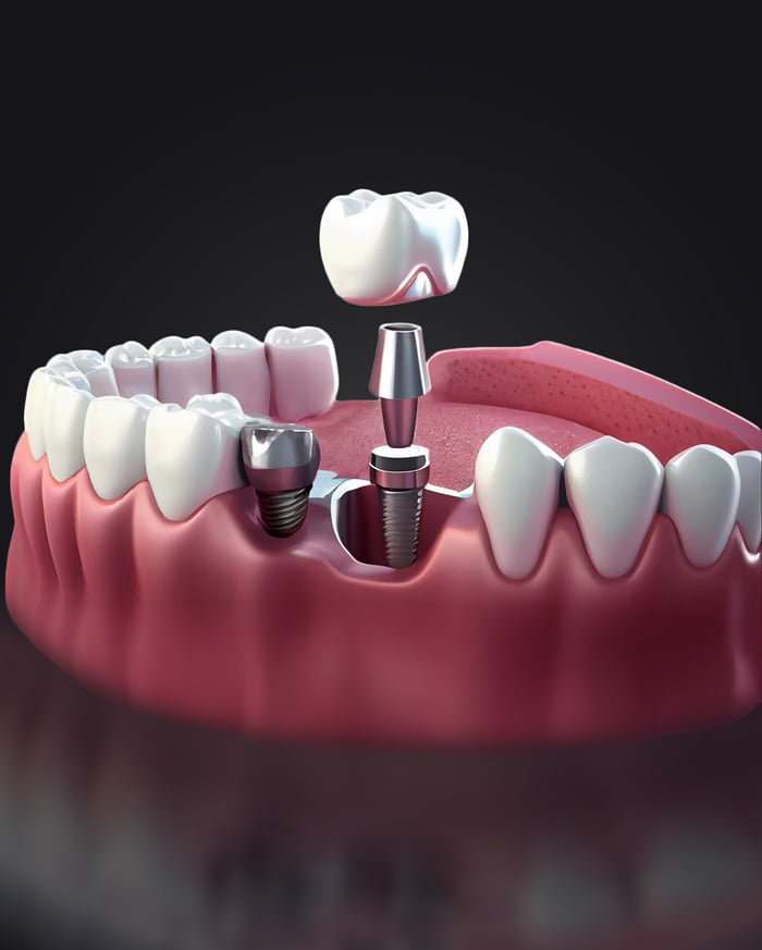 Tratament cu implanturi dentare