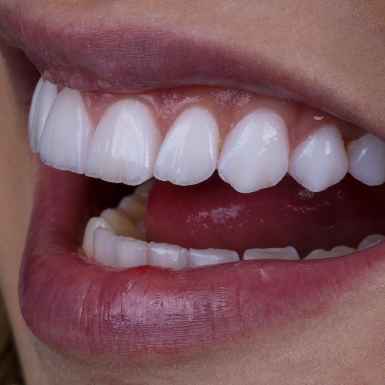 Gummy Smile